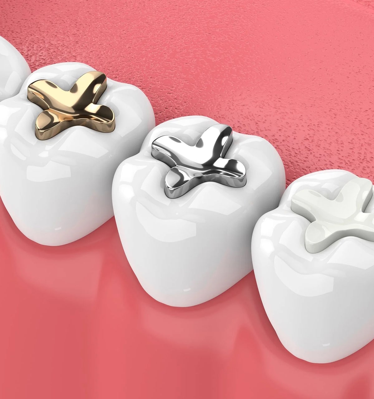 Amalgam Fillings Family Dental and Advanced Implant Center